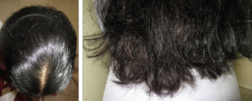 What To Do About Frizzy Broken Hair On Top Of Your Head