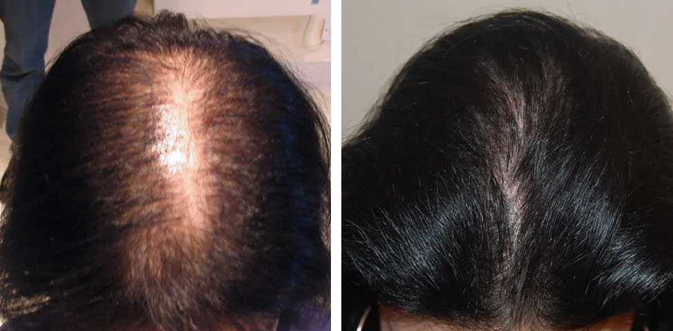 woman before and after female hair transplant