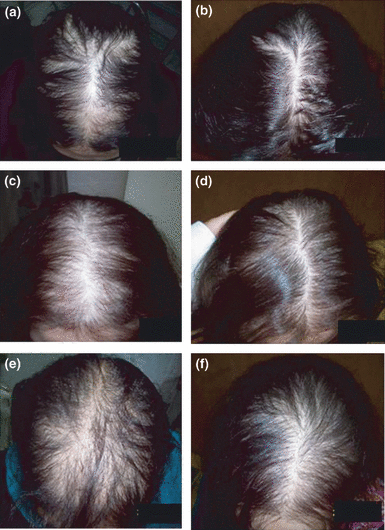 3 female patients before and 18 weeks after taking Dutasteride for hair loss