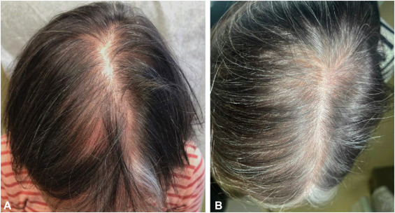 Female patient before and 18 months after taking Dutasteride for hair loss