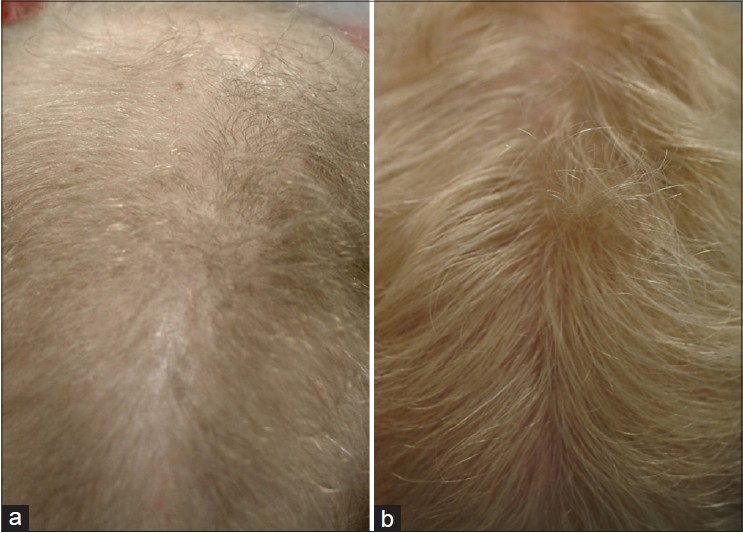 female patient's hair before and 3 years after taking Dutasteride